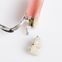 Riegel Zahnprothese