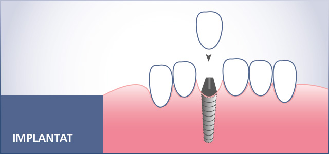 Eine implantatgetragene Zahnkrone