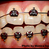 Zähne mit aufgeklebten Elementen an Zahnspange