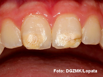 Molaren-Inzisiven-Hypomineralisation Schneidezähne eines Kindes mit MIH